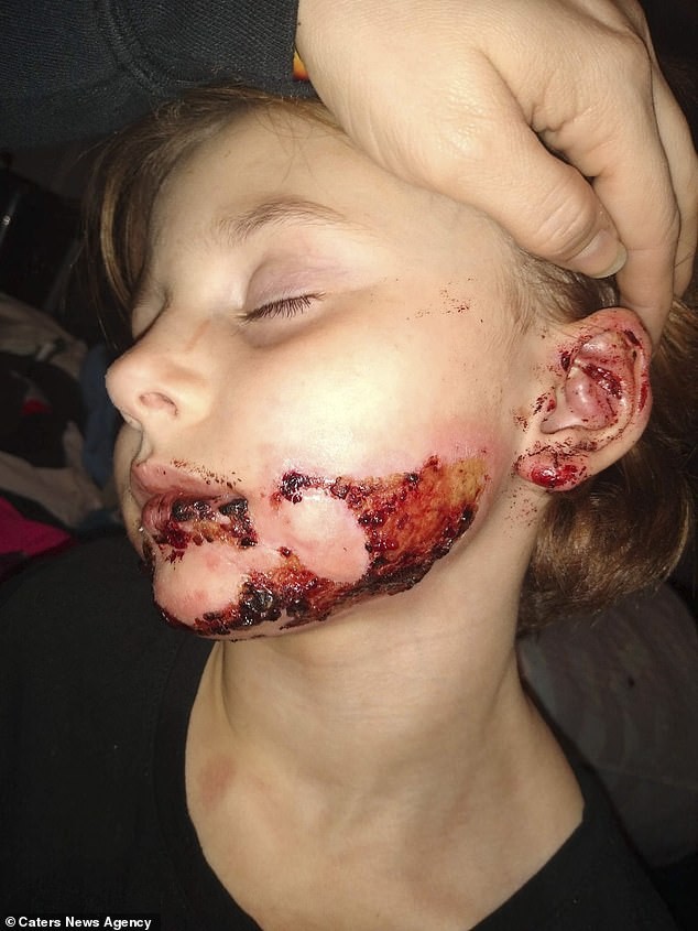 Fogo atingiu o rosto da menina (Foto: Reprodução: Daily Mail/Caters News Agency )