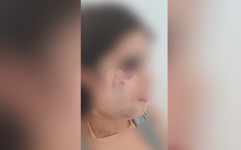 Mulher é agredida pelo companheiro e tem a mandíbula quebrada em Planaltina Goiás — Foto: Divulgação/Polícia Civil
