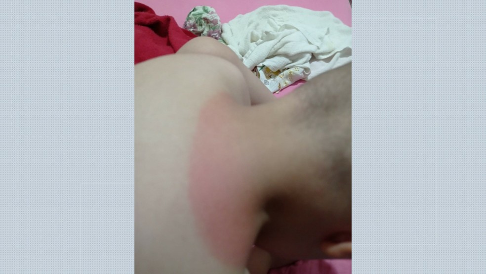 Aluno de 3 anos da Escola de Educação Infantil (EEI) Nagibe El Khouri Lian, em Ribeirão Preto, sofreu queimaduras de exposição ao sol — Foto: Arquivo pessoal