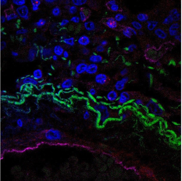 Autópsia do pulmão de paciente que faleceu por COVID-19 mostra Inflamassomas ativos marcados como pontos vermelhos em algumas células (Foto: Keyla S.G. de Sá)