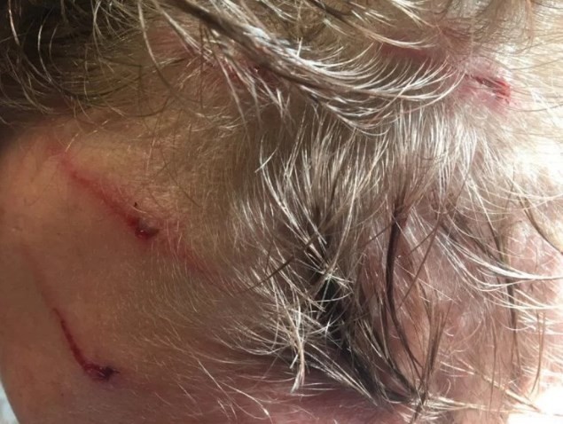 Marcas dos dentes de urso na cabeça de Dylan
