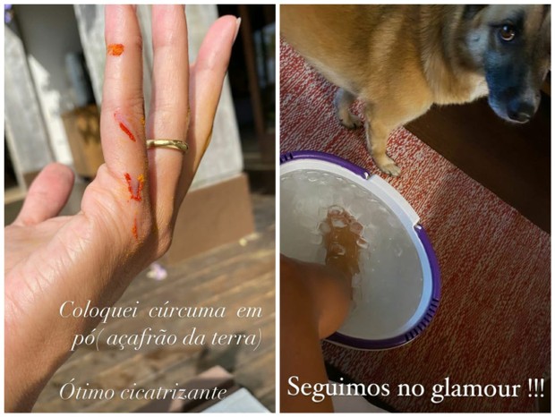 Isabella Fiorentino machucou dedo da mão e faz compressa de gelo nos pés (Foto: Reprodução/Instagram)