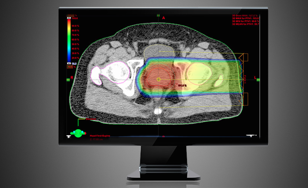 Software mostra planejamento de aplicação de radioterapia de prótons em tumores de próstata (Foto: Divulgação Varian)