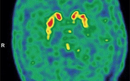 Um possível caso de doença de Parkinson associado a Covid-19 é observado pela primeira vez – Revista Galileu Um possível caso de doença de Parkinson associado a Covid-19 é observado pela primeira vez – Revista Galileu
