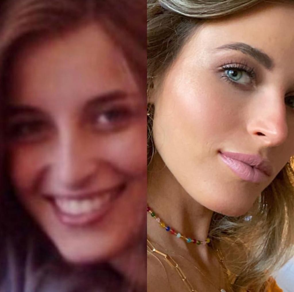 Lorena Carvalho mostra antes e depois de procedimento estético no nariz (Foto: Reprodução / Instagram)