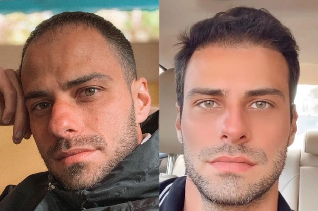 Lucas Malvacini antes e depois do transplante capilar (Foto: Reprodução/ Instagram)
