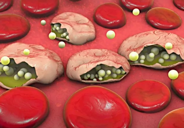 Ilustração mostra hemáceas infectadas por parasita da malária (Foto: GETTY IMAGES (via BBC))