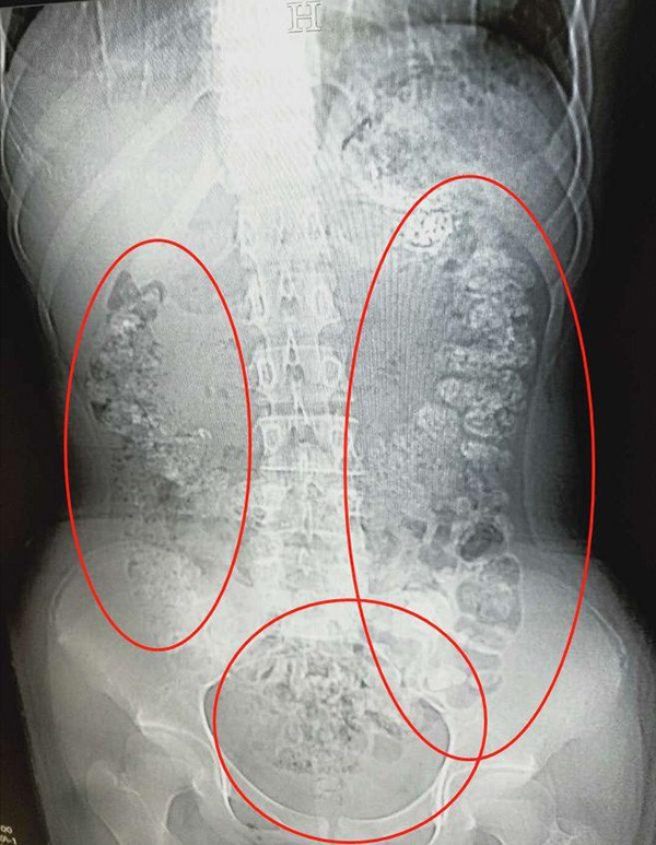 Ao realizar um exame de imagem, médico pôde observar dezenas de bolinhas de tapioca obstruindo o sistema digestivo da jovem (Foto: Weibo)