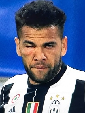 Daniel Alves olho inchado Juventus (Foto: Reprodução)