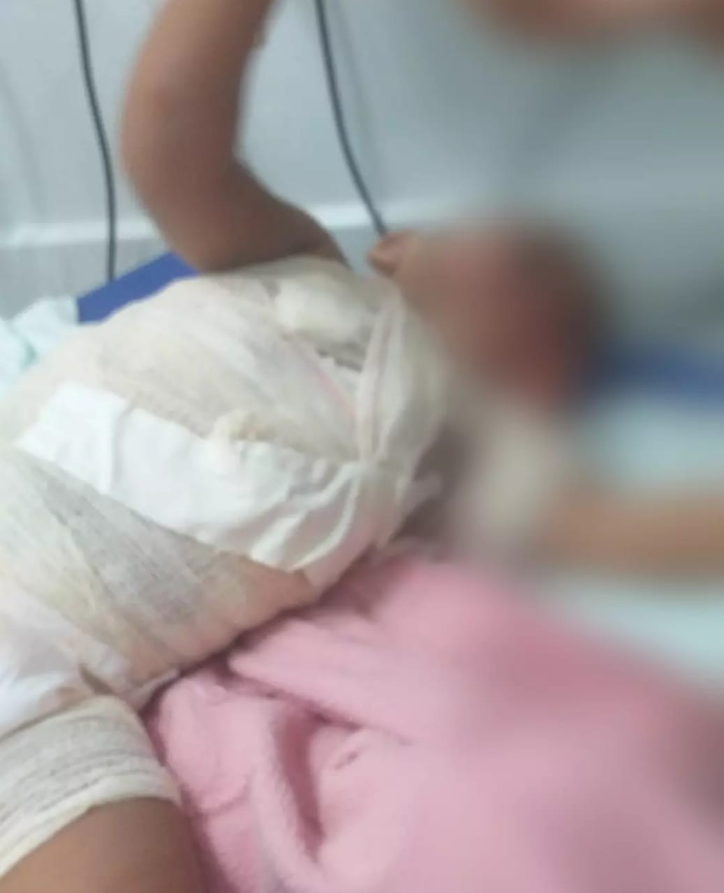 Bebê de 1 ano é internado na UTI com queimaduras de 2º grau após puxar panela de água quente de cima do fogão