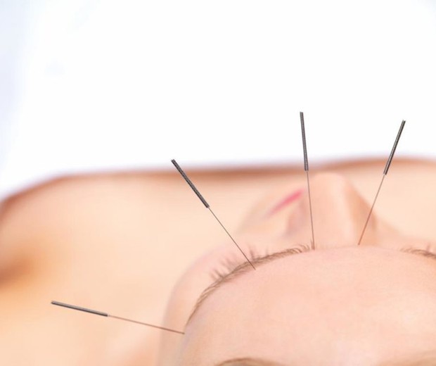 A acupuntura tem diferentes abordagens, prevenções e tratamentos (Foto: Divulgação)