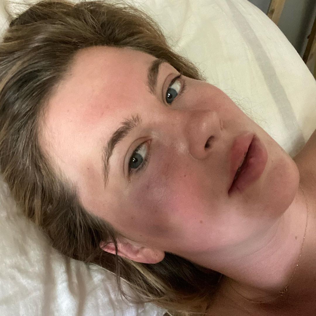 Ireland Basinger Baldwin mostra o rosto com hematomas (Foto: Reprodução/Instagram)