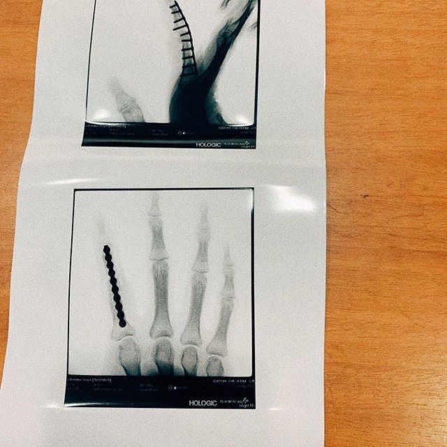 Imagem da cirurgia no dedo da atriz Liza Soberano (Foto: reprodução instagram)