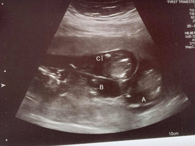 Além da surpresa da gravidez, Amy descobriu que estava esperando três bebês (Foto: Reprodução/News.com.au)