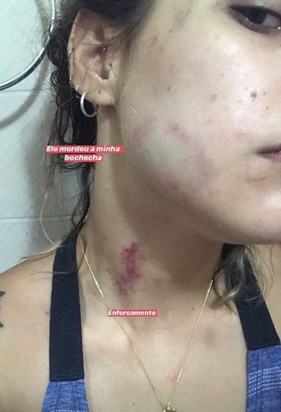 Fotos publicadas pela vítima mostram hematomas — Foto: Instagram/Reprodução