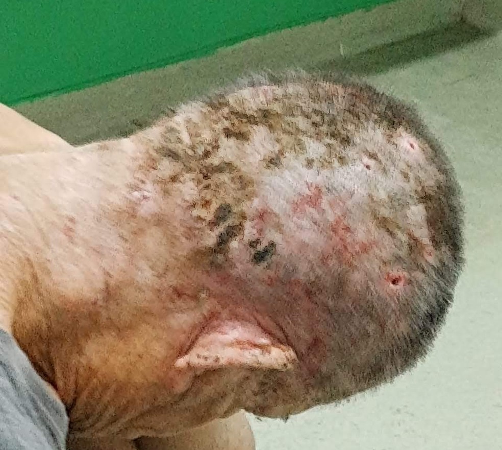 Morador de rua estava com larvas na cabeça e teve o cabelo raspada para tratamento na UPA de Peruíbe (SP) — Foto:  Bruno Chehade/Arquivo pessoal