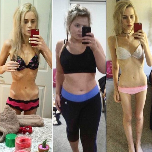 Aos 17 anos, Elle Lietzow chegou a pesar 35kg por conta da anorexia (Foto: Reprodução Instagram)