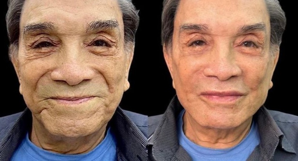 Dedé Santana mostra o antes e depois do procedimento de harmonização facial — Foto: Reprodução Instagram