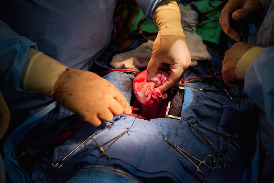 Dois pacientes recebem corações de porcos geneticamente modificados nos EUA em transplantes bem sucedidos.