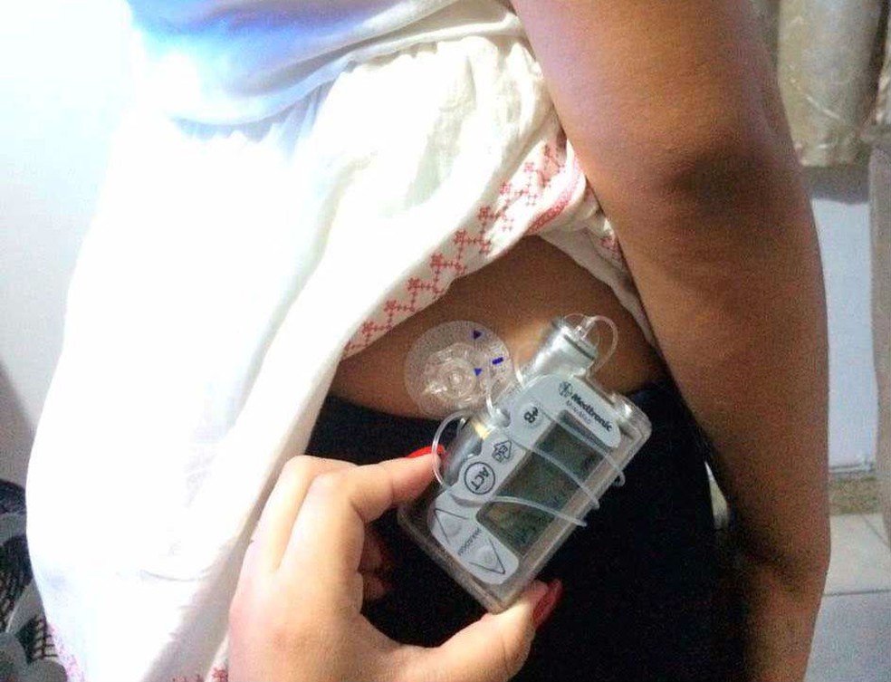 Garota usa bomba eletrônica de insulina para tratamento da diabetes (Foto: Arquivo Pessoal)