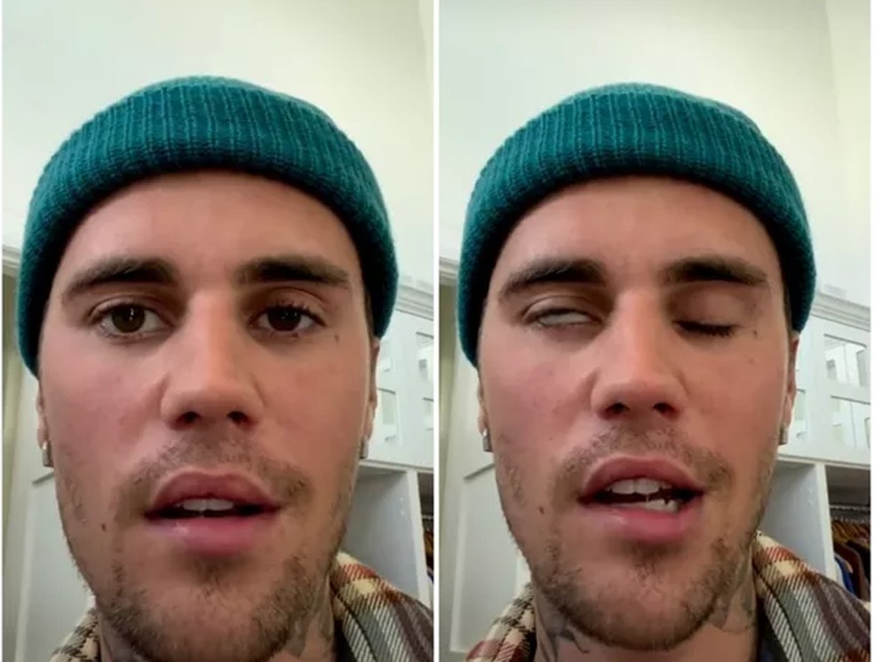 Justin Bieber: síndrome rara causa paralisia no rosto — Foto: Reprodução Instagram