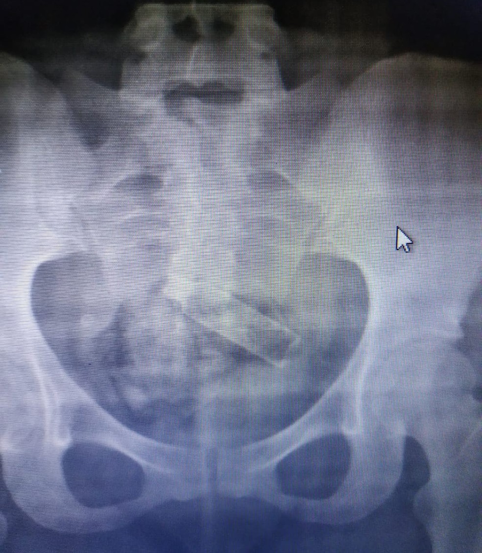 Jovem fez raio X e tomografia para confirmar droga e perfume na vagina — Foto: Divulgação/Polícia Civil
