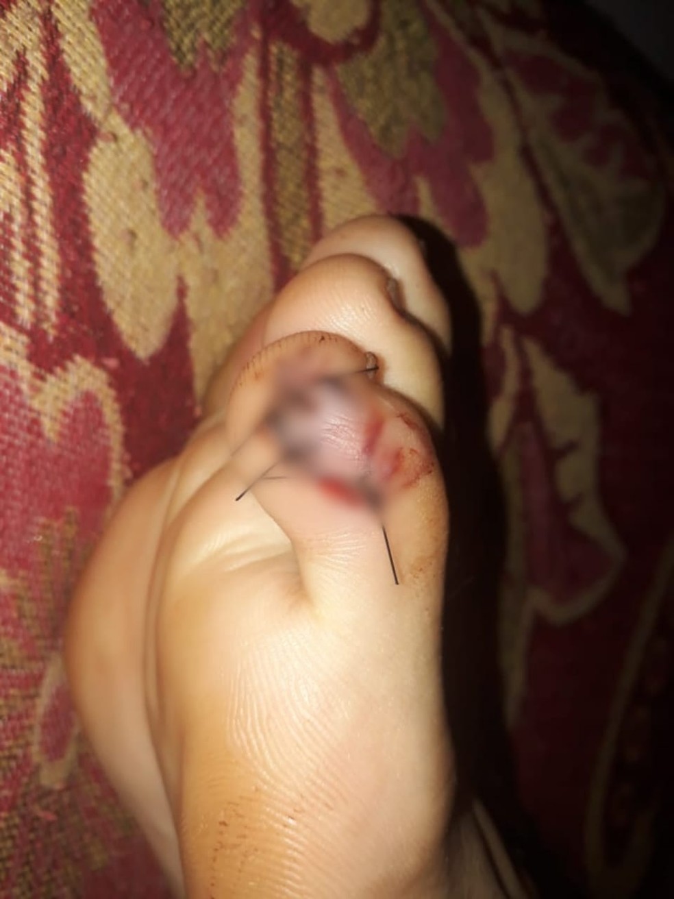 Jovem mordido no dedo do pé precisou levar pontos — Foto: Arquivo pessoal — Foto: Arquivo pessoal