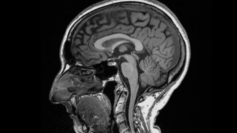 Exames de imagem revelam como infecção por coronavírus pode alterar o cérebro (Foto: UK Biobank via BBC News)