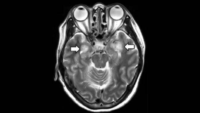 Médicos acreditam que Covid-19 pode levar à inflamação no cérebro. Exame de ressonância magnética ajudou médicos a diagnosticarem caso de encefalopatia (Foto: Radiological Society of North America)