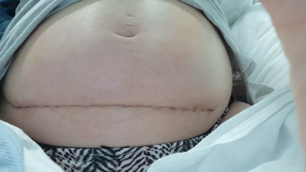 Bethan Simpson foi operada na 24ª semana de gestação para reparar a espinha bífida de sua filha — Foto: Bethan Simpson (via BBC)
