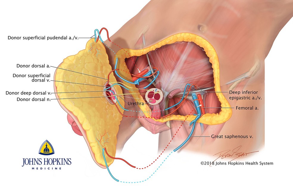 IlustraÃ§Ã£o divulgada pelo hospital mostra detalhes do procedimento mÃ©dico. (Foto: DivulgaÃ§Ã£o/Johns Hopkins Healt System)