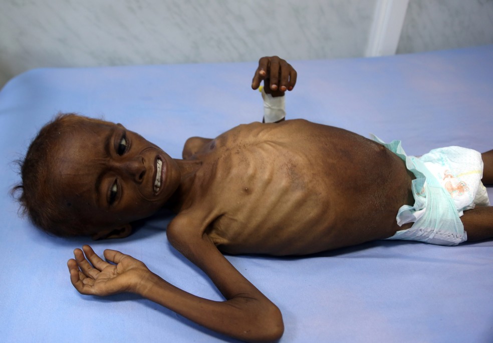Criança iemenita subnutrida recebe tratamento médico na cidade de Hodeidah  (Foto: Abd Hyder/AFP)