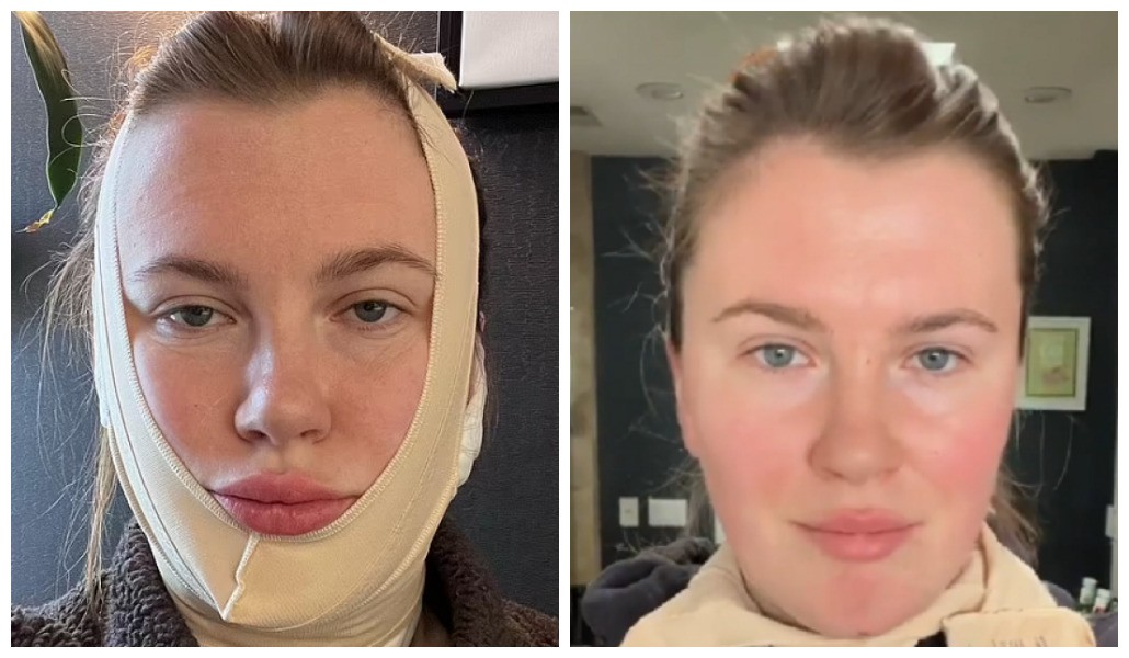 A modelo Ireland Baldwin em foto após passar por facelift e em registro mostrando o resultado do procedimento (Foto: Instagram)