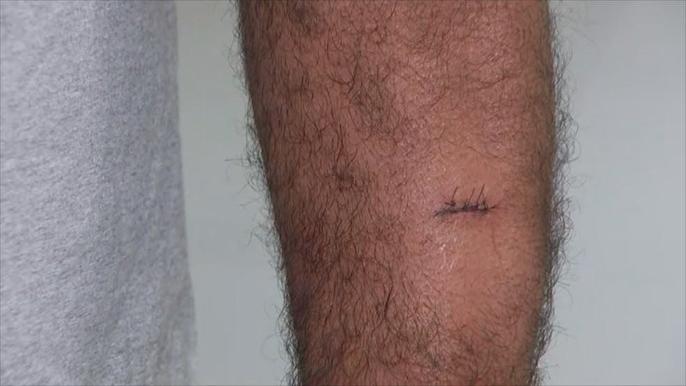 Vítima precisou de pontos para fechar machucados em Fernandópolis  — Foto: Reprodução/TV TEM 