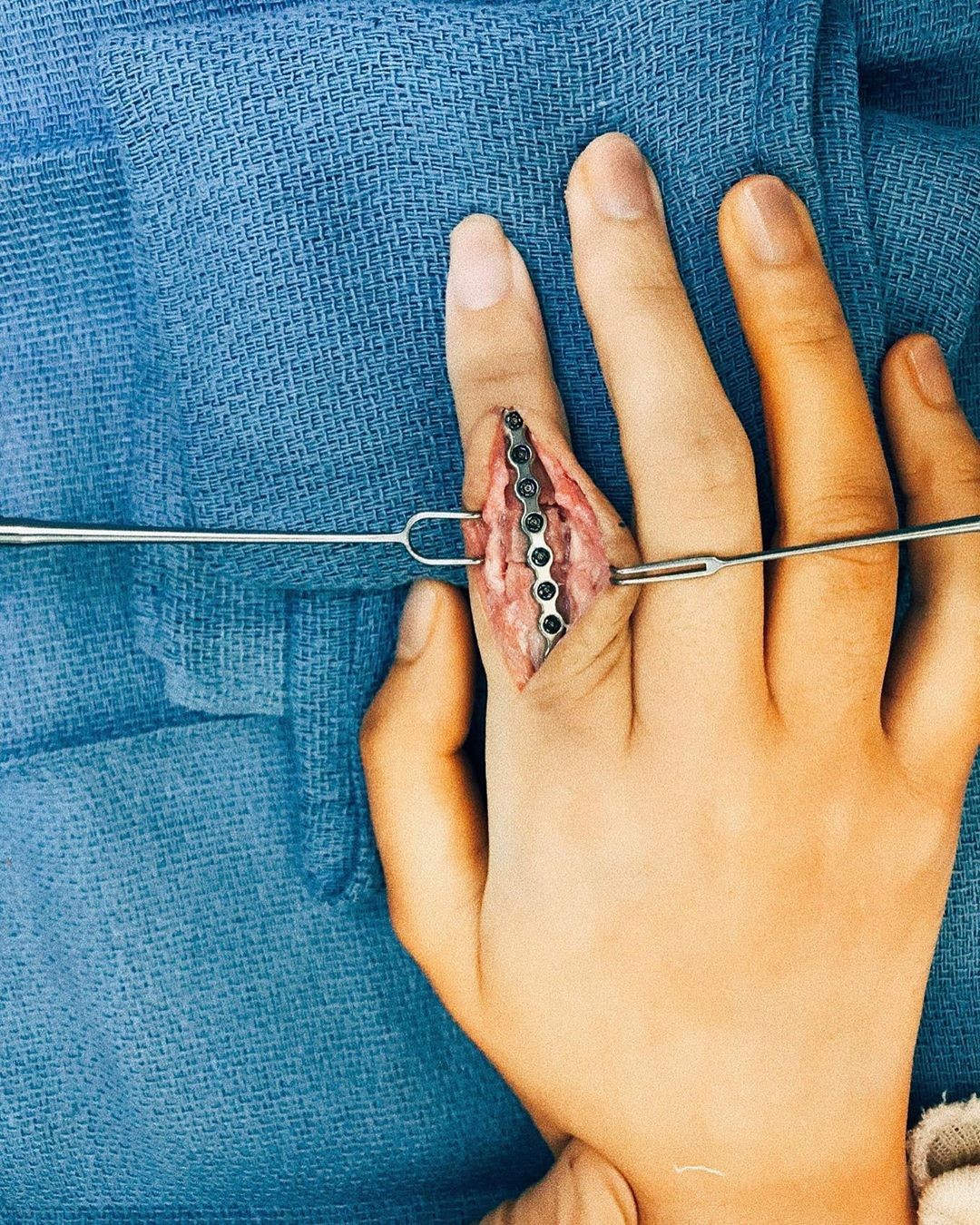 Imagem da cirurgia do dedo da atriz Liza Soberano (Foto: Reprodução instagram)