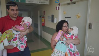 Gmeas siamesas que nasceram unidas pelo crnio so separadas aps quatro cirurgias; uma durou 27 horas