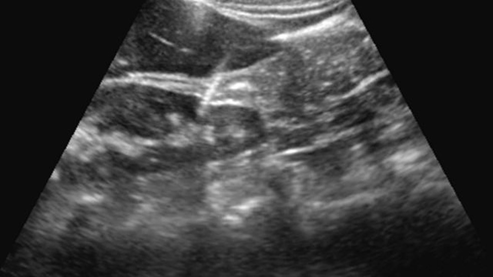 As imagens produzidas por ultrassonografia permitem que a equipe veja a posição da agulha dentro do corpo. — Foto: FMUSP via BBC