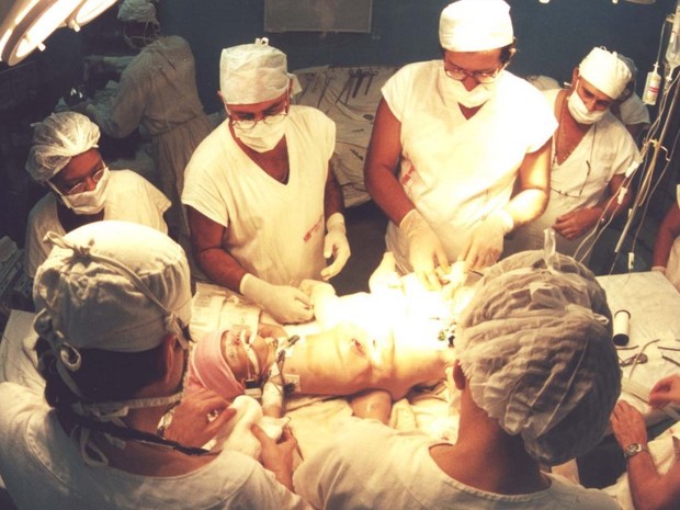 Primeira cirurgia de separação de siameses é realizada em julho de 2000, em Goiás (Foto: Cristina Cabral/ O Popular)