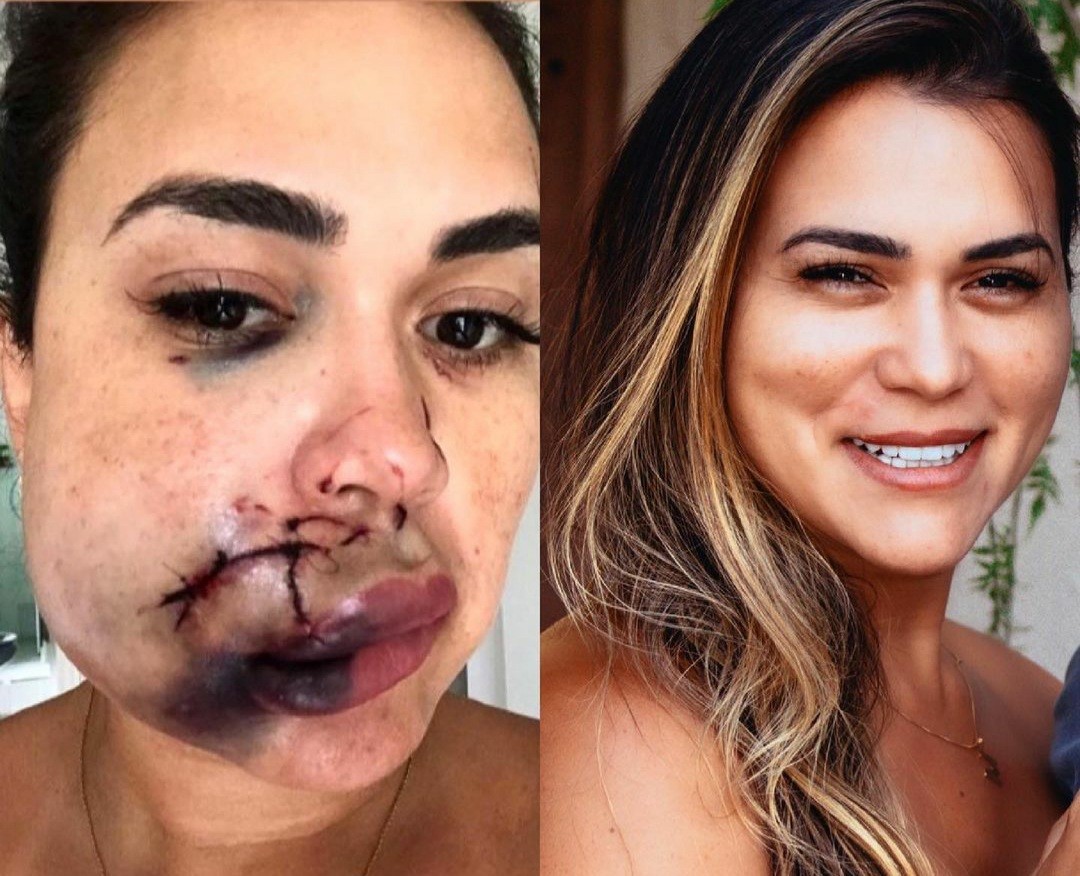 Milka Borges em janeiro de 2020 e atualmente: lesão gravíssima e cicatriz irreversível  (Foto: Reprodução / Instagram )