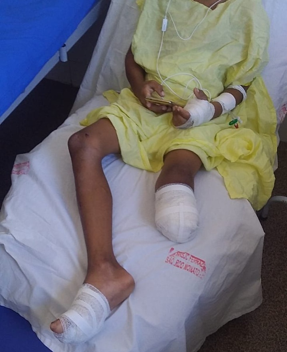 Menino de 9 anos tem perna amputada ao cair de ônibus escolar em Dirceu Arcoverde, Sul do Piauí — Foto: Divulgação