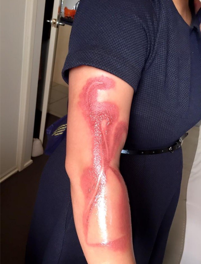 Não é tatuagem, é queimadura de segundo grau