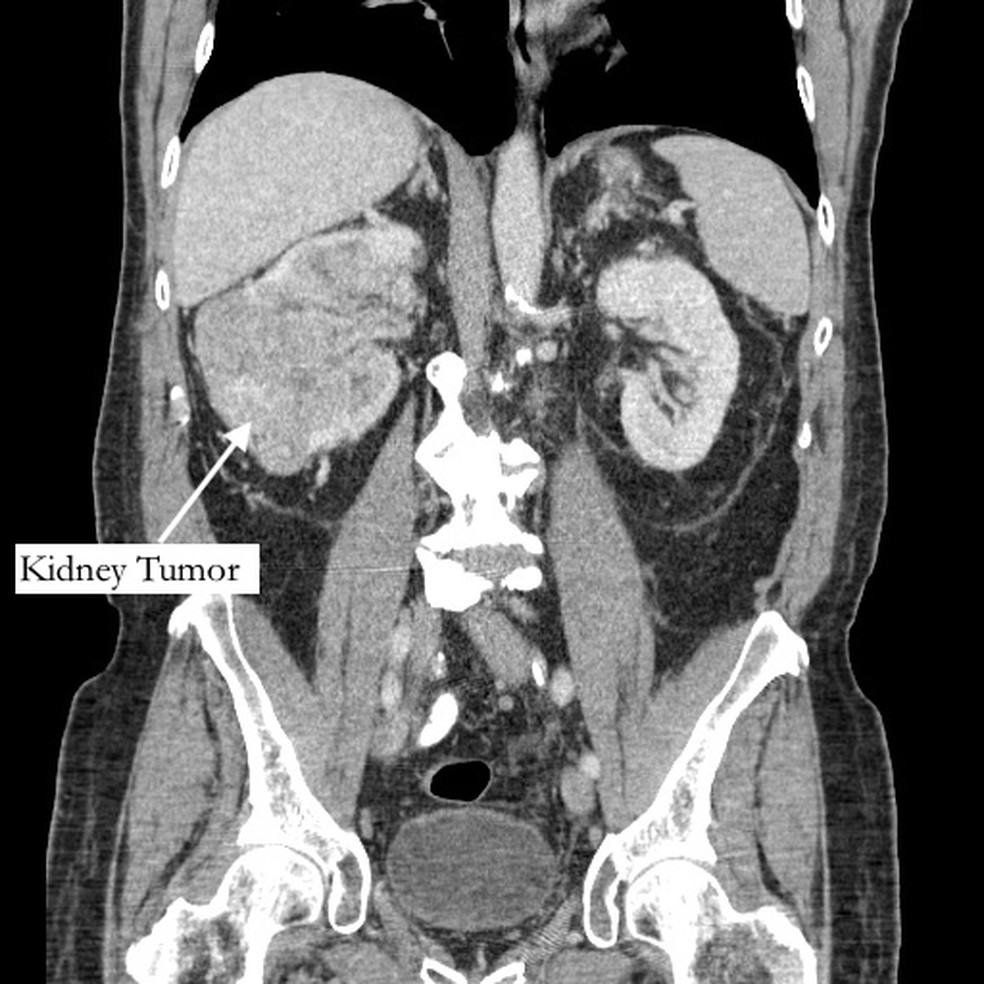 Tomografia de Bernstein mostrando seu tumor no rim. — Foto: Northwell Health/Divulgação
