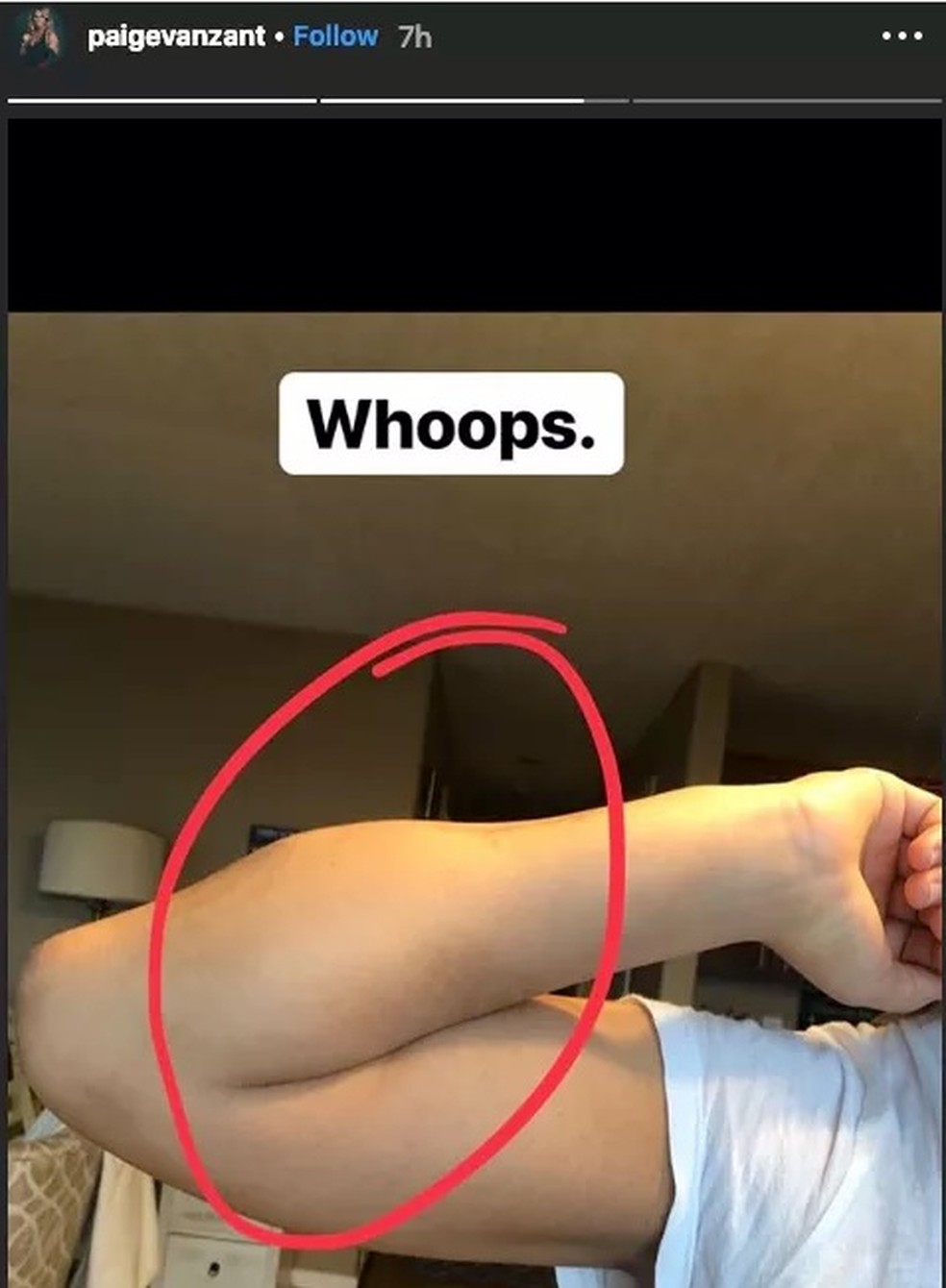 Paige VanZant postou a foto do seu braço quebrado nos treinos para o UFC 236 — Foto: Reprodução / Instagram