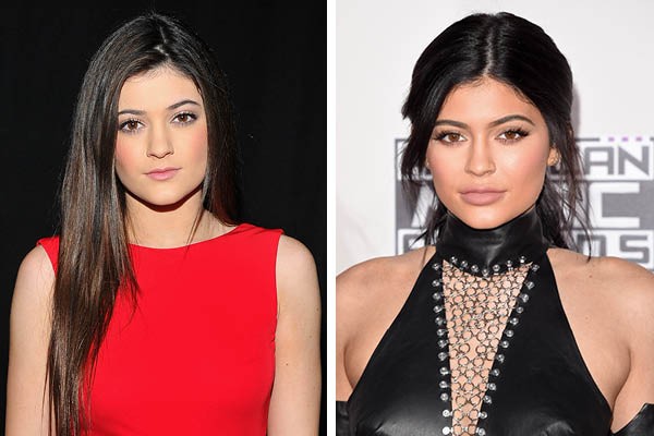 Kylie Jenner: antes e depois (Foto: Getty Images)