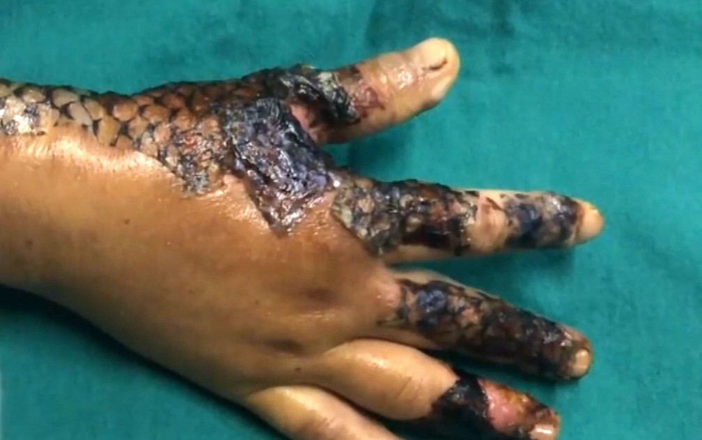 Criança com pele de tilápia aplicada na recuperação de cirurgia da síndrome de Apert no Hospital Sobrapar, em Campinas — Foto: Reprodução/EPTV