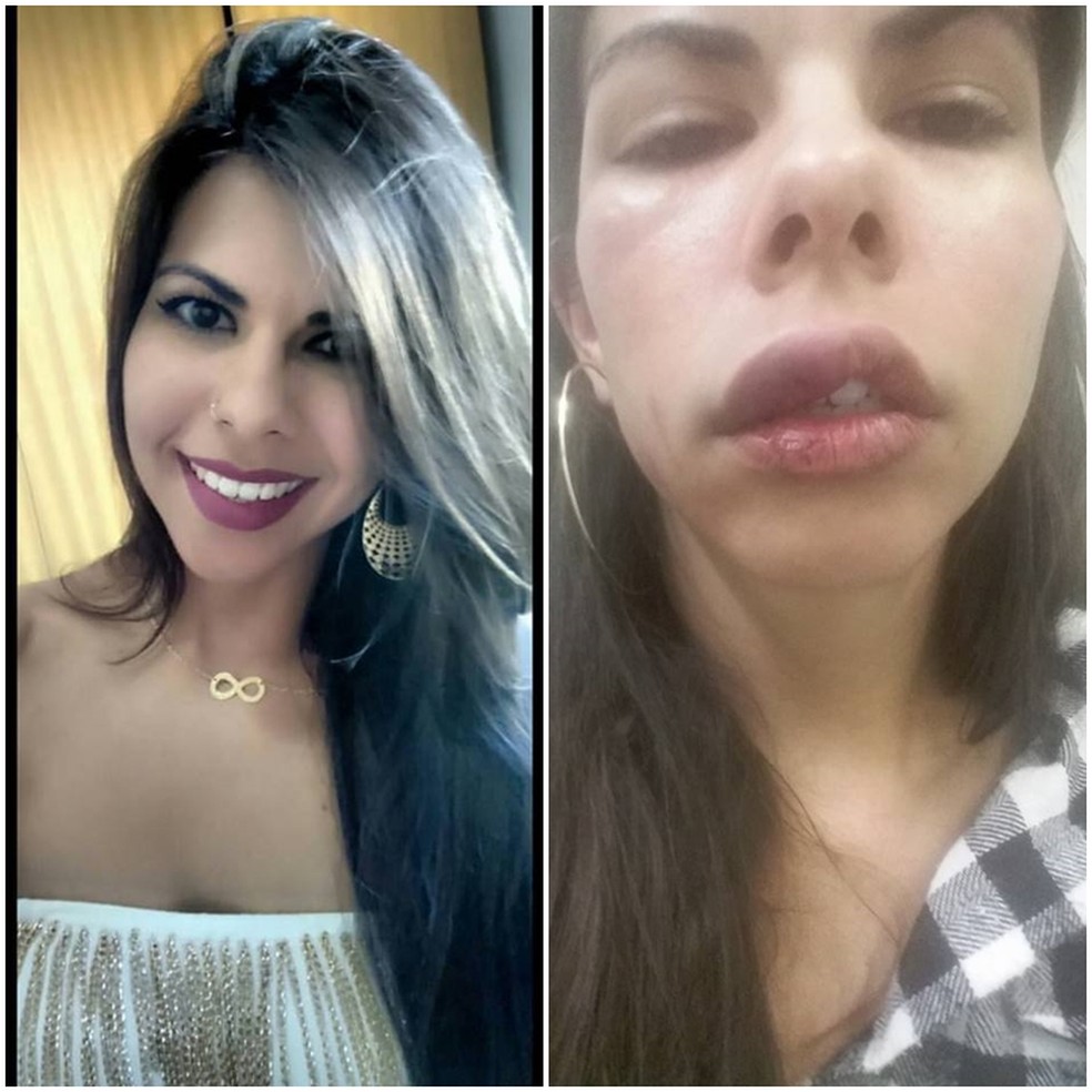 Carla Januário, de Votuporanga (SP), foi agredida pelo namorado e compartilhou imagem dos ferimentos nas redes sociais para encorajar outras vítimas de agressões a denúnciar o crime (Foto: Carla Januário/Arquivo Pessoal)