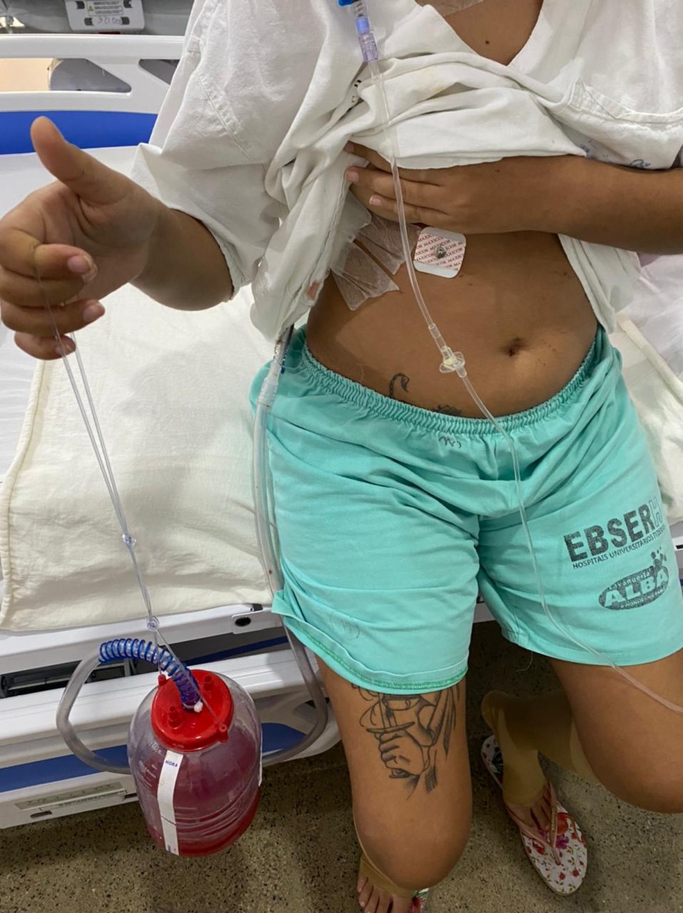 Lvia Monteiro ficou usando dreno devido  cirurgia  Foto: Lvian Monteiro/Arquivo pessoal