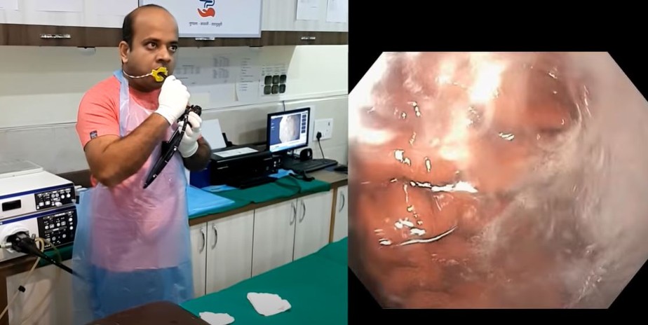 Médico realiza endoscopia nele mesmo na Índia