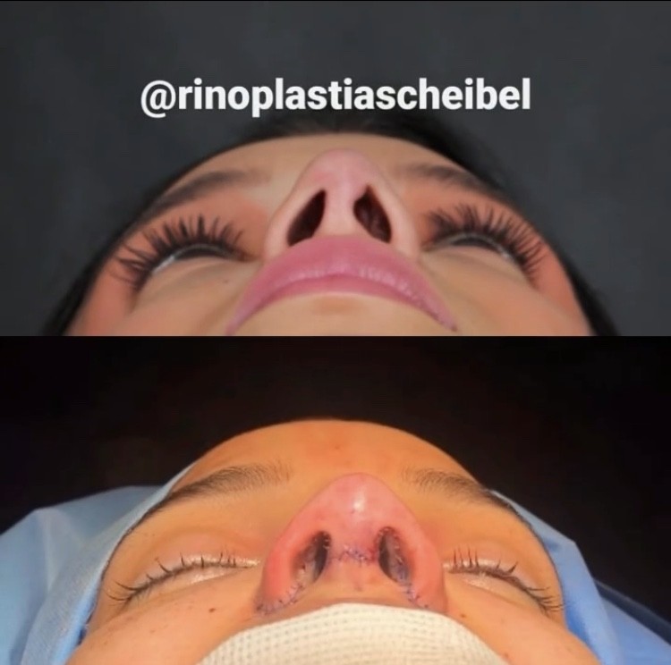 Jakelyne e Mariano mostram resultado de rinoplastia (Foto: Reprodução/Instagram)
