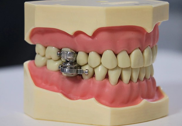 Prótese com o DentalSlim (Foto: Divulgação/ Universidade de Otago)